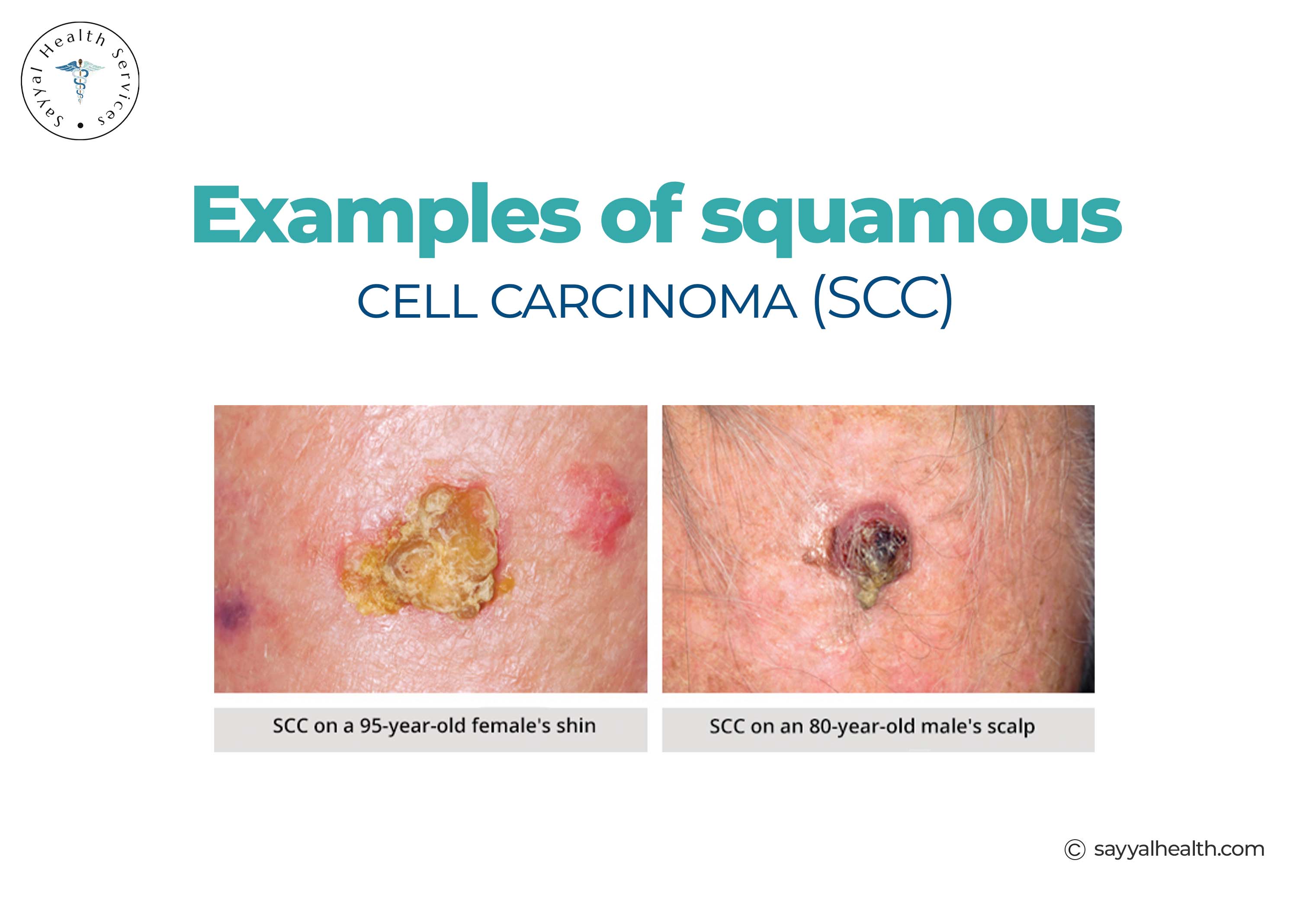 Squamous Cell Carcinoma